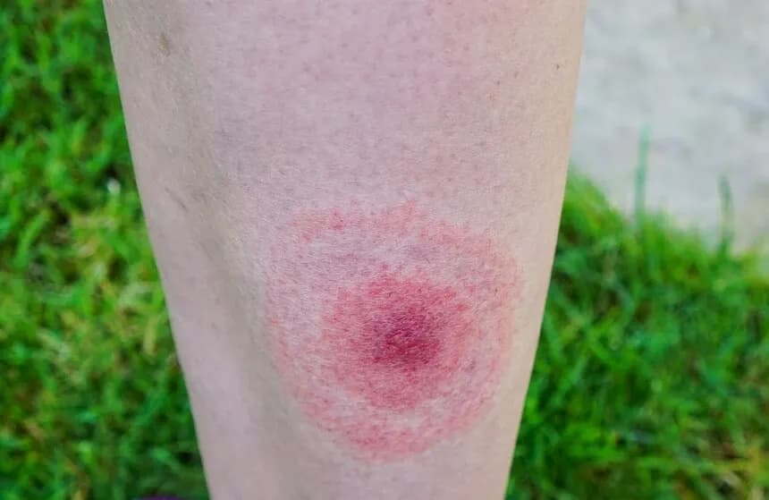 Czy rumień po kleszczu boli? Poznaj niepokojące objawy boreliozy