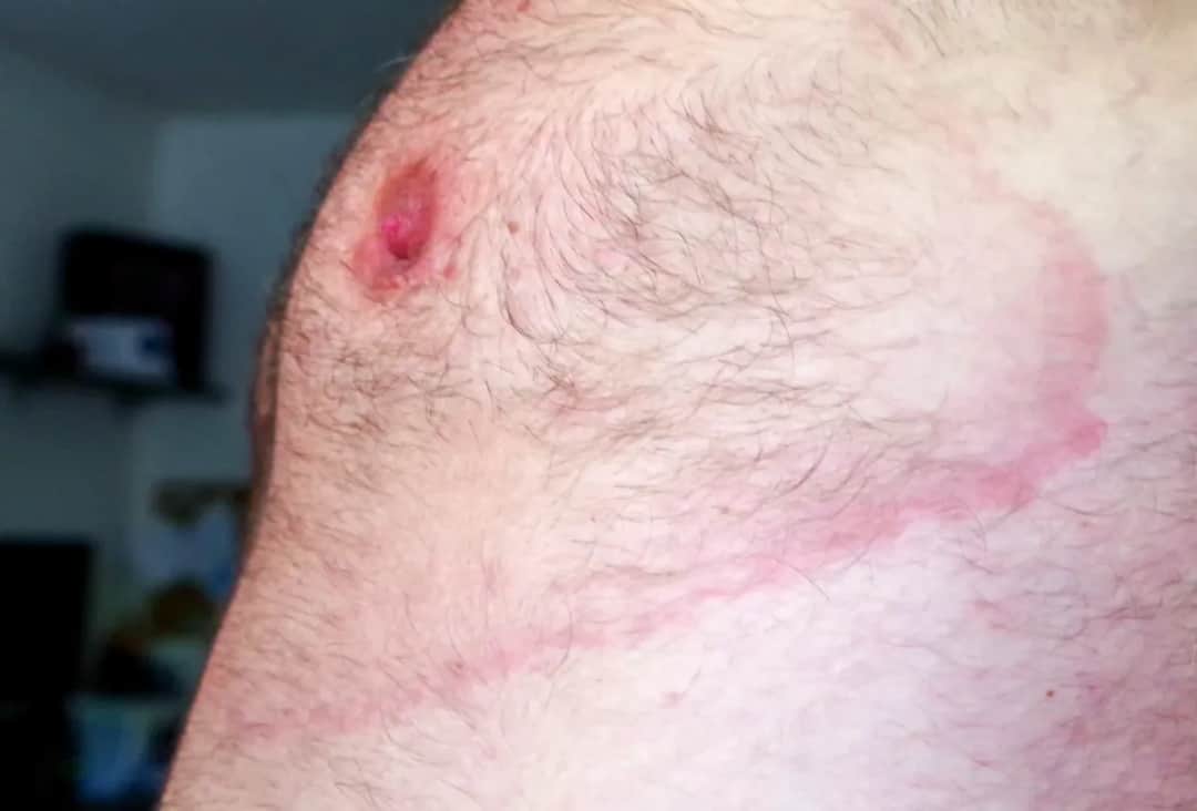 Czy rumień po kleszczu swędzi? Objawy, które musisz znać i kiedy iść do lekarza