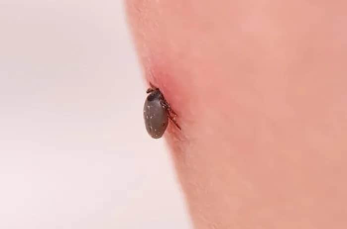 Jak wyjąć głowę kleszcza i uniknąć poważnych problemów zdrowotnych