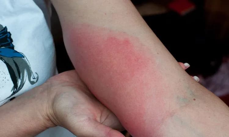 Jak wygląda rana po kleszczu? Objawy, rumień i co robić po ukąszeniu