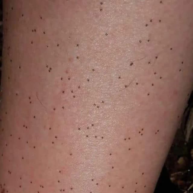 Jak wygląda kleszcz na skórze? Rozpoznaj i uniknij niebezpieczeństwa ukąszenia