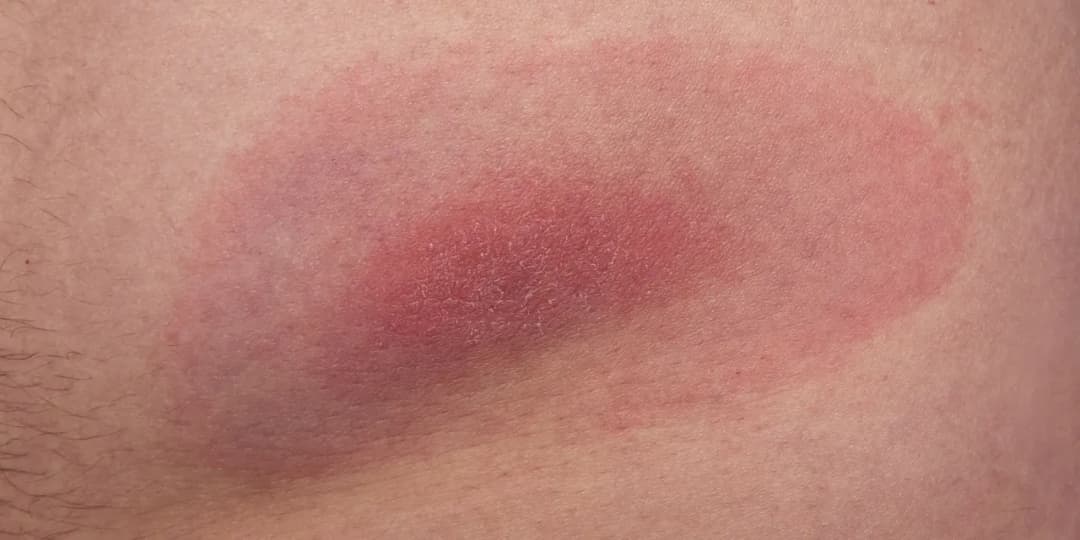 Jak długo swędzi ugryzienie po kleszczu? Objawy, które zaskakują